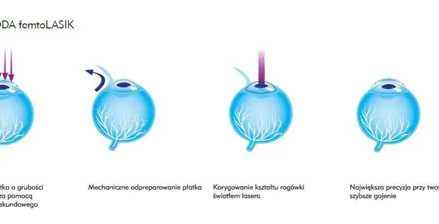 Korekcja krótkowzroczności: Od okularów po laser wybierz mądrze!