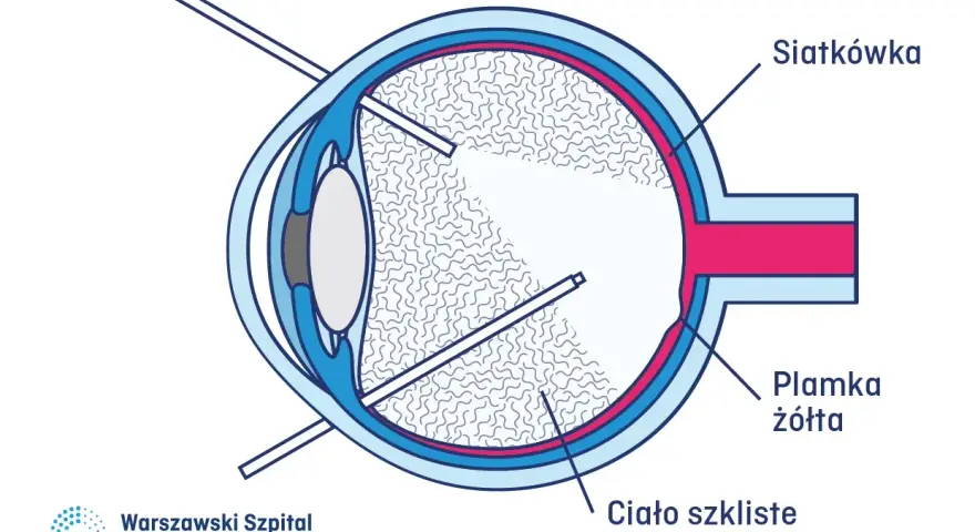 Schemat oka z zaznaczoną siatkówką, plamką żółtą i ciałem szklistym. Wskazuje na proces gojenia po fotokoagulacji siatkówki.