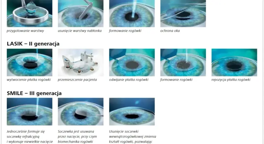 Laserowa korekcja wzroku czy boli? Grafiki pokazują etapy zabiegów PRK, LASIK i SMILE, ilustrując, jak precyzyjnie przywracana jest ostrość widzenia.