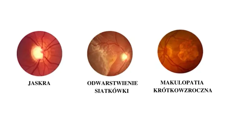Krótkowzroczność: Jak zatrzymać postęp wady i odzyskać ostry wzrok?
