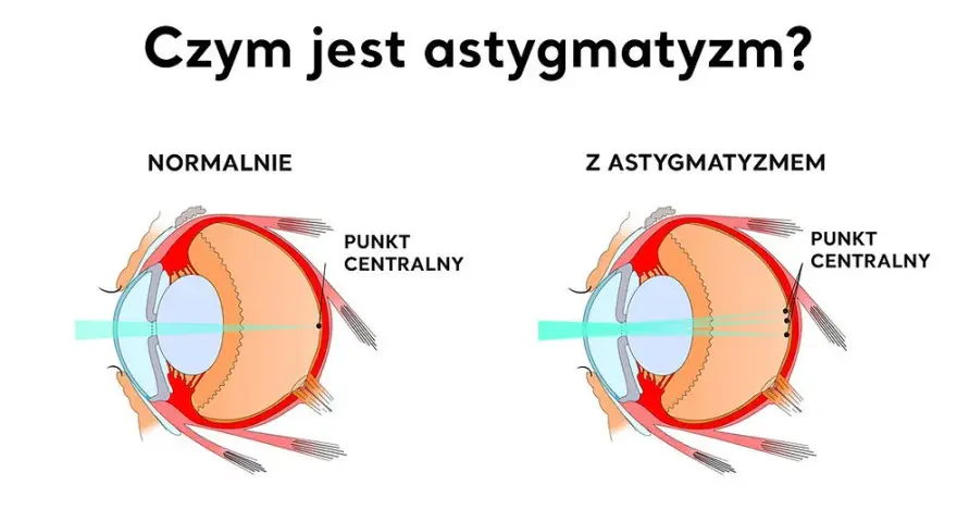 Astygmatyzm: Kiedy do okulisty, a kiedy do optometrysty?