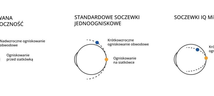 Schemat oka z ogniskowaniem światła przy krótkowzroczności i korekcji soczewkami.
