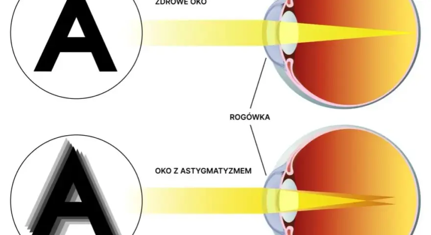 Astygmatyzm: czy się pogłębia? Stabilność wady, czynniki zmian